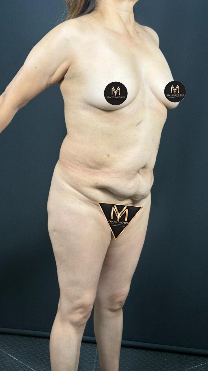 Abdominoplastia: antes