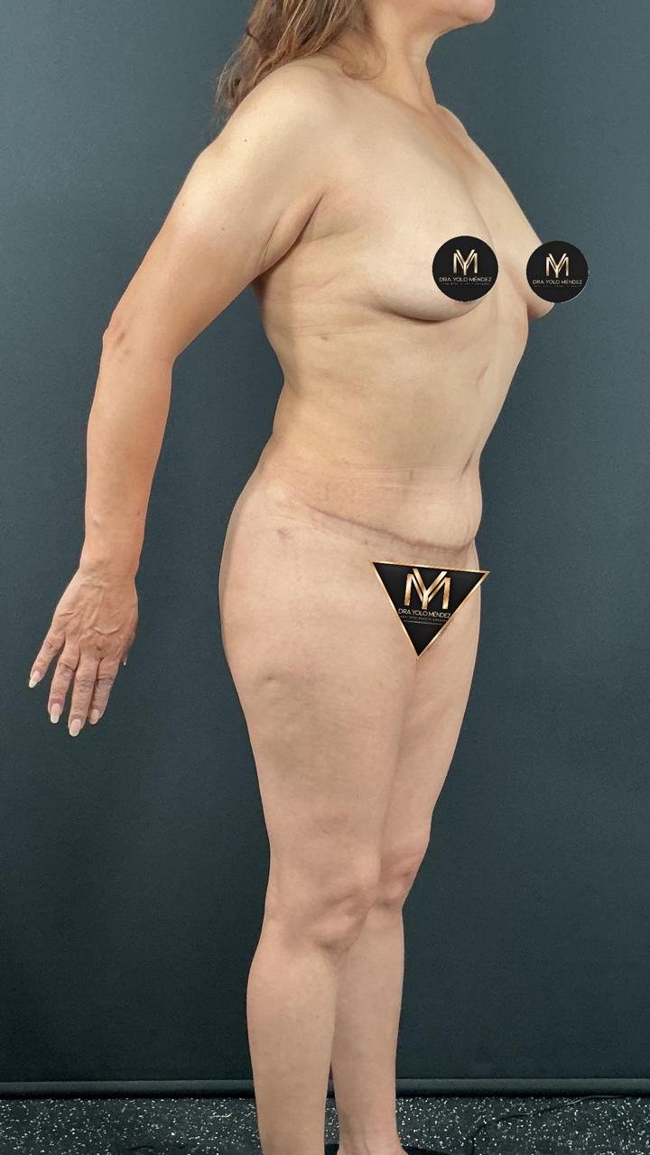 Abdominoplastia: después