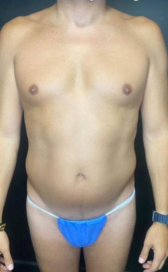 Lipo HD masculina · 3 meses: antes