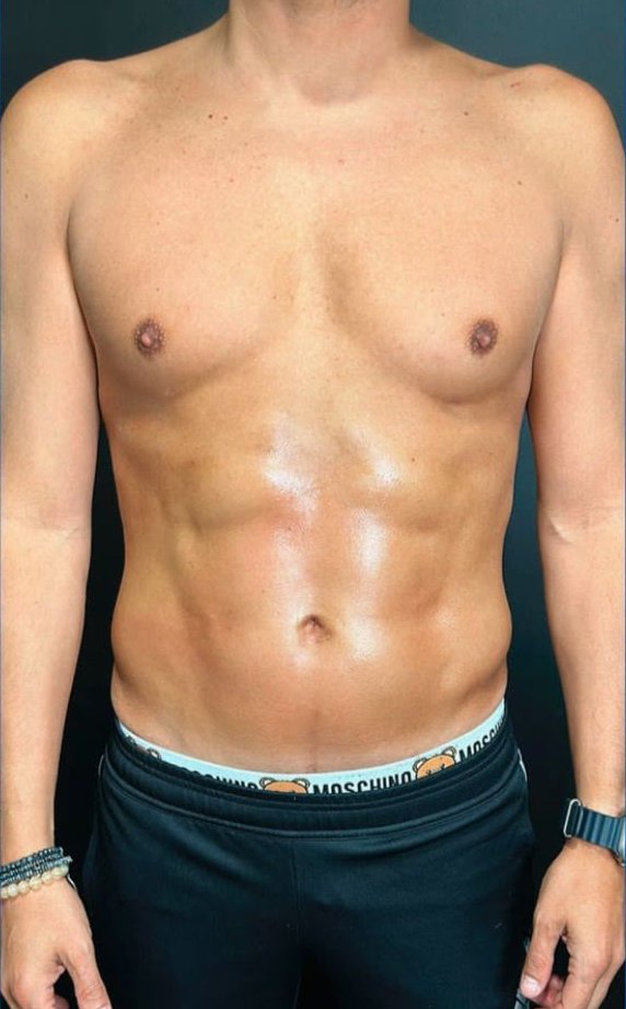 Lipo HD masculina · 3 meses: después
