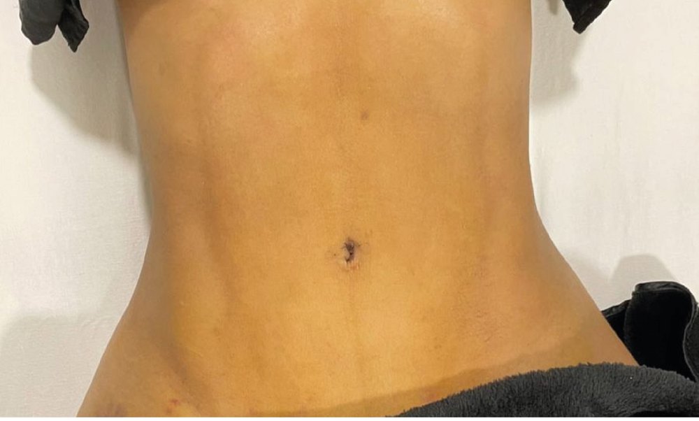 LipoVaser Soft Definition + Renuvion: después